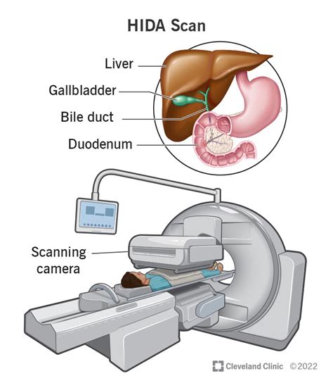 HIDA Scan: What It Is, Purpose, Procedure & Results .